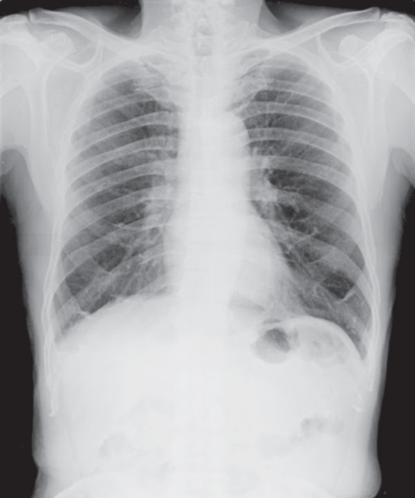 Study Medical Photos Costochondral Calcification Seen On Chest XRay