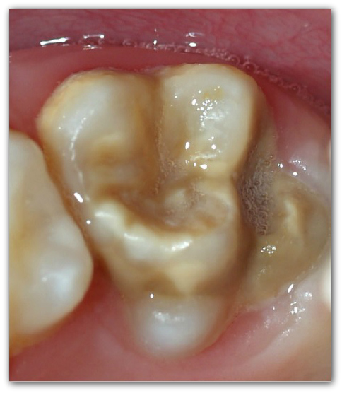 Hipoplasia dental, dientes blancos, manchas marrones