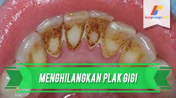 Cara Menghilangkan Plak Gigi dengan Resep Alami Tanpa Bantuan Dokter