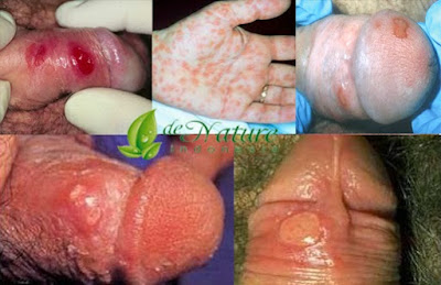 Lecet Lecet Di Ujung Dan Kepala Penis Lecet Lecet Di Ujung Dan Kepala Penis