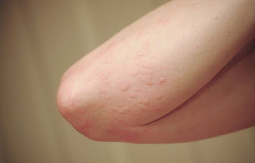  Biduran atau urtikaria ialah reaksi kulit terhadap alergi yang ditandai dengan munculnya 12 Obat Biduran di Apotik Paling Ampuh untuk Anak dan Dewasa 