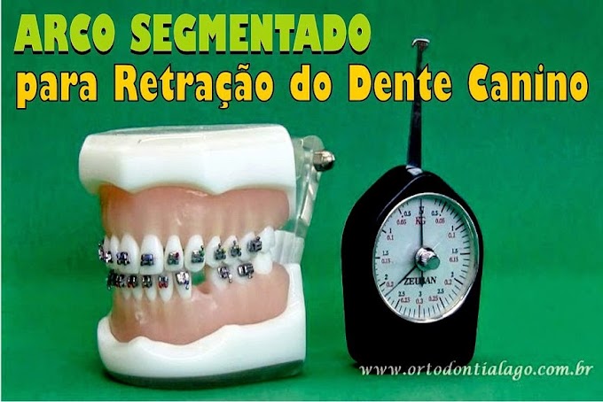 ORTODONTIA: Arco Segmentado para Retração do Dente Canino