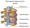 Лечение протрузии в Одессе и протрузия дисков лечение Одесса