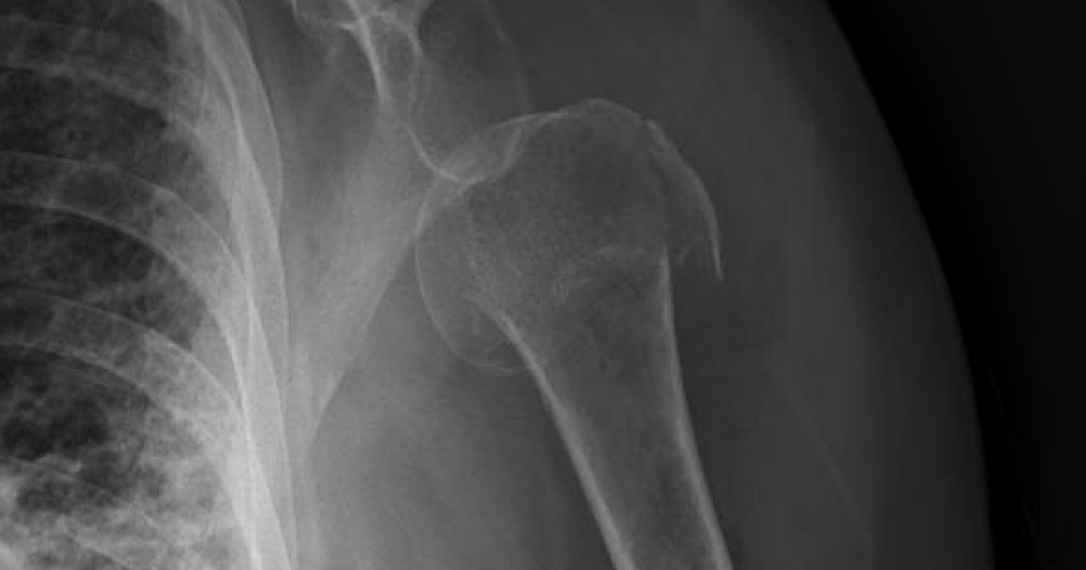 Shoulder and Elbow Surgery Shoulder subluxation after proximal humerus