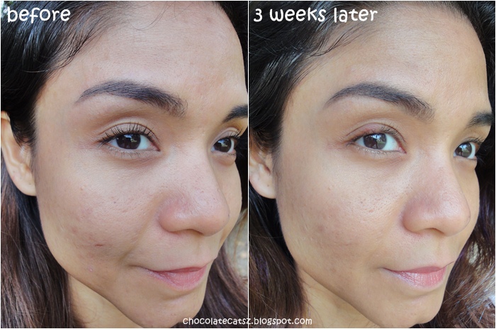 Clinique Step Before And After | vlr.eng.br
