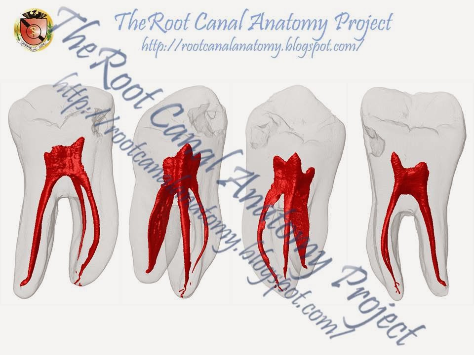 The root canal anatomy project mandibular first molar vertucci type iv 