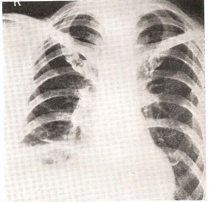 Clinical types Chest Diseases