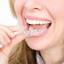 Khay niềng răng Clear Aligner và các đặc điểm đặc trưng
