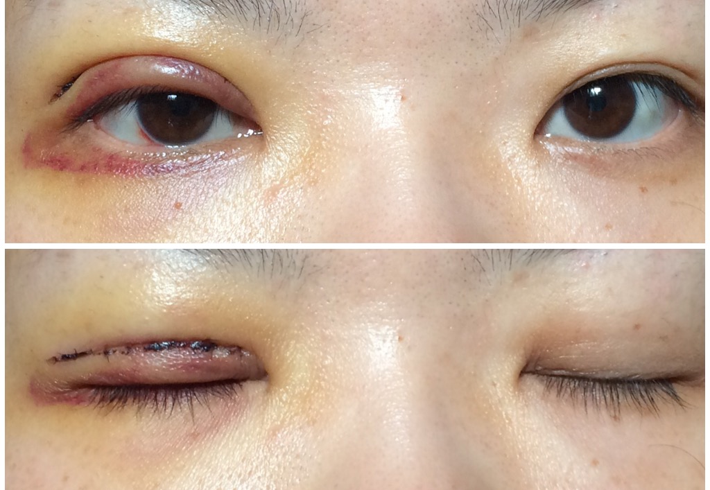 二重（ふたえ）全切開手術 手術後4日目 二重(ふたえ）整形、全切開への道