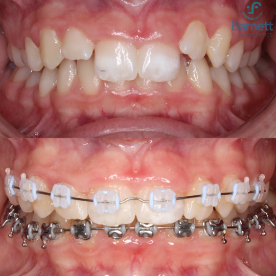 Orthodontics Blog Invisalign, Braces & More in Akron Ohio