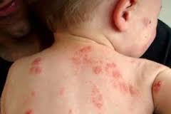 Cara Herbal Sederhana Mengobati Eksim Menyiksa, Apa Obat Gatal Ada Di Bokong Karena Eksim?, Bagaimana Cara Mengobati Gatal Eksim?