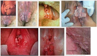 Foto Salep Herbal bentol bentol Merah pada kemaluan