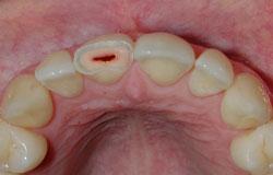Trauma Endodontics
