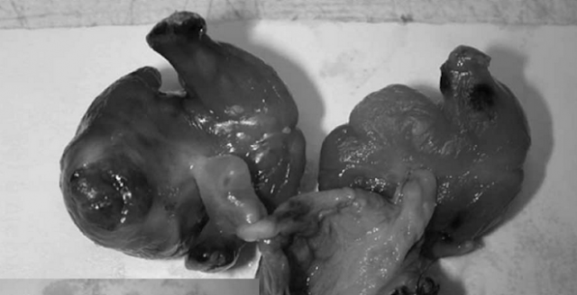 Bayi Lahir Dengan Kondisi Perut Buncit, Ternyata 2 Makhluk Ini Bersarang Di Rahimnya! Bayi Lahir Dengan Kondisi Perut Buncit, Ternyata 2 Makhluk Ini Bersarang Di Rahimnya!