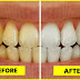 Top 6 Natural Tips to Make Yellow Teeth to White