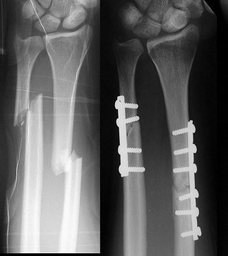Fiksasi patah tulang lengan radius ulna - Medianers