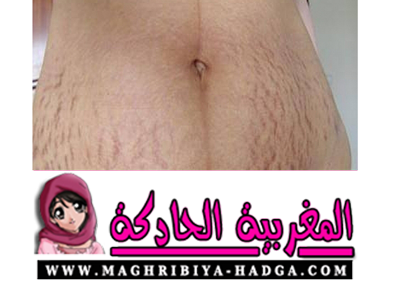 وصفة للتخلص من تشققات البطن بعد الولادة المغربية الحادكة