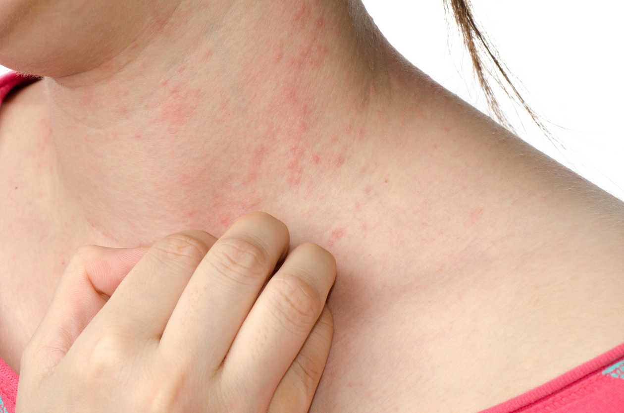 Huevo alergicos al alimentos para