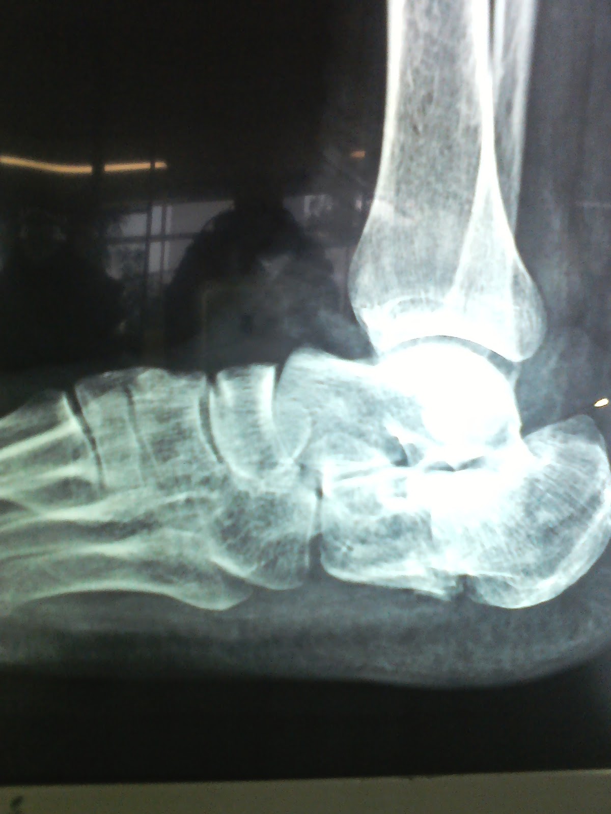 O R T O C R I T I C A: FRACTURA DE CALCANEO CON AFECCION PARTES BLANDAS