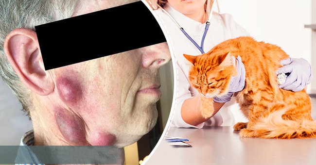 This Man Is Left With Painful Balls On The Neck, The Doctors Say That The Cat Is The Cause