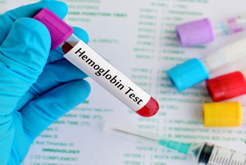 Mengenal Macam-Macam Metode Pemeriksaan Kadar Hemoglobin