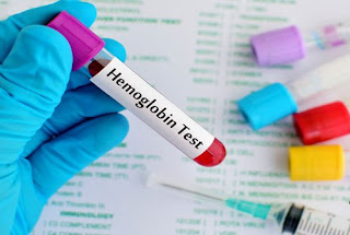 hemgolobin normal,hemoglobin normal,hemoglobin normal berapa,hemoglobin normal ibu hamil,hemoglobin normal adalah,hemoglobin normal pada bayi,hemoglobin normal anak,hemoglobin normal range who,hemoglobin normal pria dan wanita,hemoglobin normal pria dewasa,hemoglobin normal range by age,hemoglobin normal pada wanita,hemoglobin normal range female,hemoglobin normal count,hemoglobin normal level for male,hemoglobin normal range child,hemoglobin normal levels canada,hemoglobin normal range uk,hemoglobin normal lab values,hemoglobin normal range pregnancy,hemoglobin normal ferritin low,hemoglobin normal and abnormal,hemoglobin normal range,hemoglobin normal aralık,hemoglobin normal aralığı,hemoglobin normal allele,hemoglobin normal anemia,hemoglobin normal and iron low,hemoglobin normal age,hemoglobin normal adults,normal hemoglobin a1c,hemoglobin a1c normal range,normal hemoglobin and hematocrit,hemoglobin a2 normal range,normal hemoglobin aa sequence,hemoglobin a1c normal range by age,hemoglobin above normal,normal hemoglobin a1c for diabetics,normal hemoglobin a1c pediatrics,hemoglobin a1c normal range canada,hemoglobin normal but mcv low,hemoglobin normal but hematocrit low,hemoglobin normal but ferritin low,hemoglobin normal but mchc low,hemoglobin normal but low iron,hemoglobin normal but rbc low,hemoglobin normal but rbc high,hemoglobin normal blood levels,hemoglobin normal blood test,hemoglobin normals by age,hemoglobin below normal,normal hemoglobin by age pediatrics,hemoglobin below normal range,normal hemoglobin baby,normal hemoglobin blood count,normal hemoglobin blood cell count,normal hemoglobin boy,normal hemoglobin but anemic,normal hemoglobin but low iron levels,hemoglobin normal count in blood,hemoglobin normal count for female,hemoglobin normal child,hemoglobin normal chart,normal hemoglobin count for male,normal hemoglobin count for pregnant,normal hemoglobin count for woman,normal hemoglobin canada,hemoglobin child normal range,normal hemoglobin chains,hemoglobin cbc normal range,hemoglobin concentration normal range,normal hemoglobin chromatogram,low ferritin normal hemoglobin causes,mean corpuscular hemoglobin normal range,normal mean corpuscular hemoglobin,mean cell hemoglobin normal range,normal hemoglobin level child,hemoglobin normal dewasa,hemoglobin normal değeri,hemoglobin normal değerler,hemoglobin normal demir eksikliği,hemoglobin normal değerleri kaçtır,hemoglobin normal distribution,hemoglobin normal delivery,normal hemoglobin during pregnancy,normal hemoglobin dna,normal hemoglobin during third trimester,normal hemoglobin decreased mcv,normal hemoglobin dogs,normal hemoglobin definition,hemoglobin d normal range,hemoglobin determination normal values,normal hemoglobin derivatives,normal hemoglobin decreased hematocrit,hemoglobin normal değer,hemoglobin normal değeri nedir,hemoglobin normal değeri kaç olmalı,hemoglobin normal elderly,normal hemoglobin electrophoresis,hemoglobin e normal range,hemoglobin estimation normal range,normal hemoglobin electrophoresis thalassemia,normal hemoglobin electrophoresis in newborn,normal hemoglobin levels,normal hemoglobin elevated mcv,normal hemoglobin europe,normal hemoglobin estimation,hemoglobin estimation normal values,high hemoglobin normal epo,elevated hemoglobin normal epo,hemoglobin normal range elderly,elevated rbc normal hemoglobin,elevated hematocrit normal hemoglobin,normal hemoglobin levels elderly,low mcv normal hemoglobin electrophoresis,elevated rdw normal hemoglobin,erythrocytosis with normal hemoglobin,hemoglobin normal for female,hemoglobin normal food,hemoglobin normal fa,hemoglobin normal for infant,hemoglobin normal for male,hemoglobin normal ferritin high,normal hemoglobin for a 3 year old,normal hemoglobin for 80 year old man,hemoglobin for normal delivery,hemoglobin f normal range,normal hemoglobin for 70 year old male,normal hemoglobin for pregnant,normal hemoglobin for pregnancy,normal hemoglobin for newborn,normal hemoglobin for teenage girl,normal hemoglobin for age,low hemoglobin normal ferritin pregnancy,low iron normal hemoglobin normal ferritin,normal range for hemoglobin,hemoglobin normal g/l,normal hemoglobin gm dl,normal hemoglobin gene,normal hemoglobin genotype,normal hemoglobin gm,normal hemoglobin growth,normal hemoglobin glycated,normal hemoglobin levels g/l,normal hemoglobin teenage girl,normal hemoglobin levels g/ml,hemoglobin a1c normal but glucose high,glucose normal hemoglobin a1c high,beginning of normal hemoglobin gene