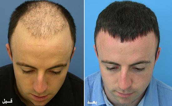 10 من الآثار الجانبية الشائعة لزراعة الشعر