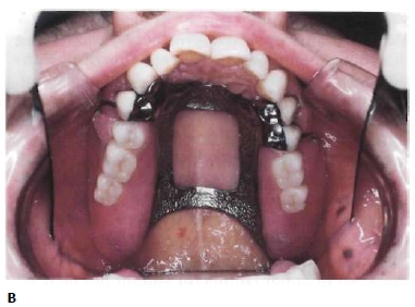 hiphoplife: Maxillary major connectors : Types