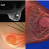 Eliminate 100% of Breast Cysts by This Natural Home Remedies