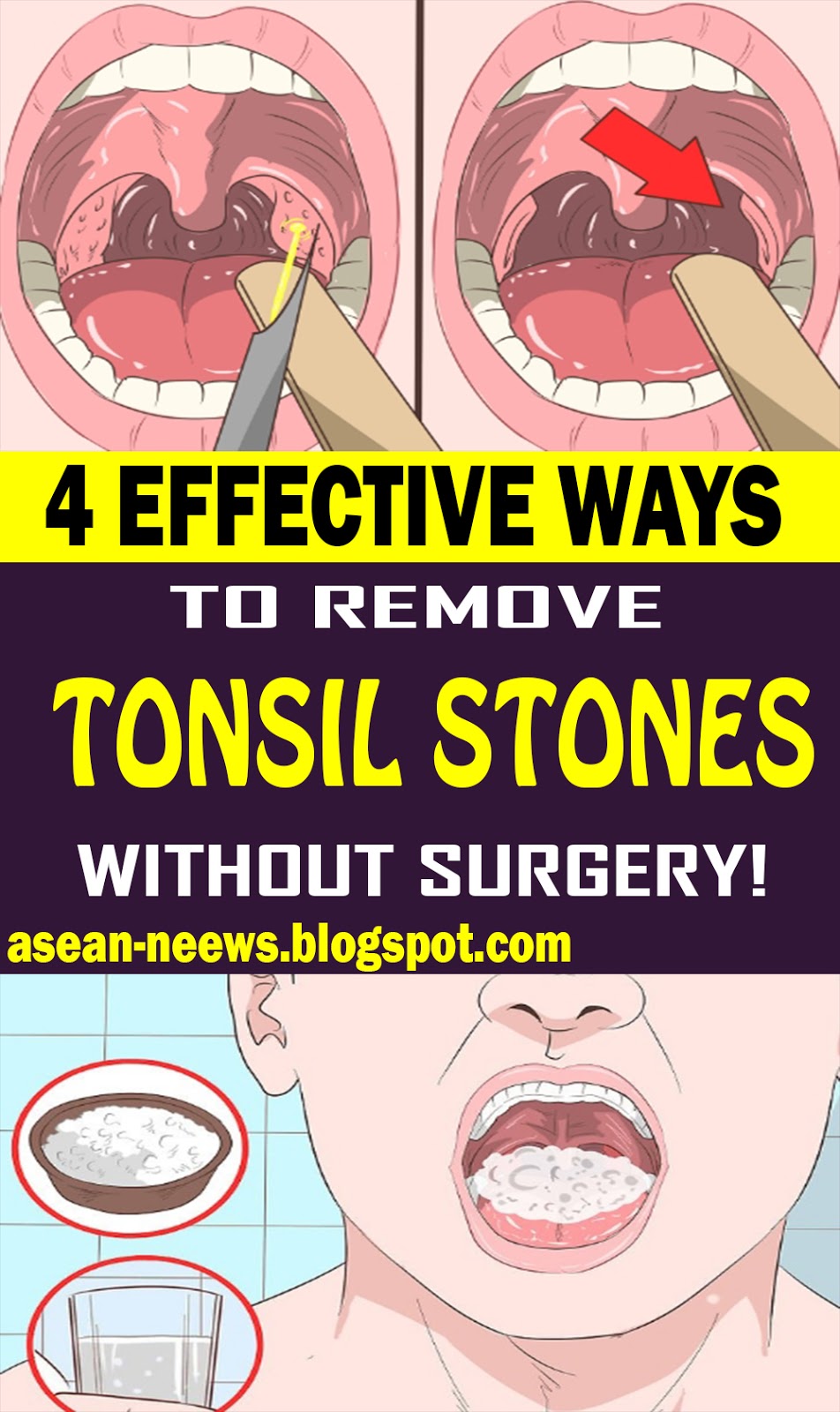 4 Effective Ways To Remove Tonsil Stones Without Surgery Health And