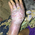 <h3>PENYAKIT ANTRAKS MENULAR DARI HEWAN KE MANUSIA</h3> thumbnail