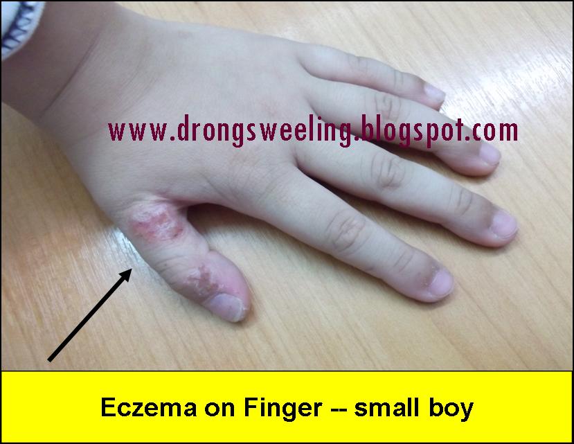TCM News How Effective Can TCM Cure Eczema 湿疹 with Chinese Natural Herbs
