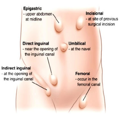 Spigelian hernia Pictures, Symptoms, Causes, Recovery, Repair
