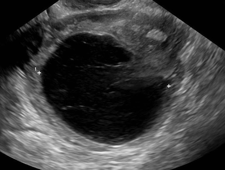 фолликулометрия узи доминантный фолликул. геморрагическая киста яичников на узи. текалютеиновые кисты на узи. текалютеиновые кисты яичников на узи. фолликулярный яичник на узи.