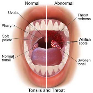 Penyebab bau mulut dari gigi, gusi dan lidah