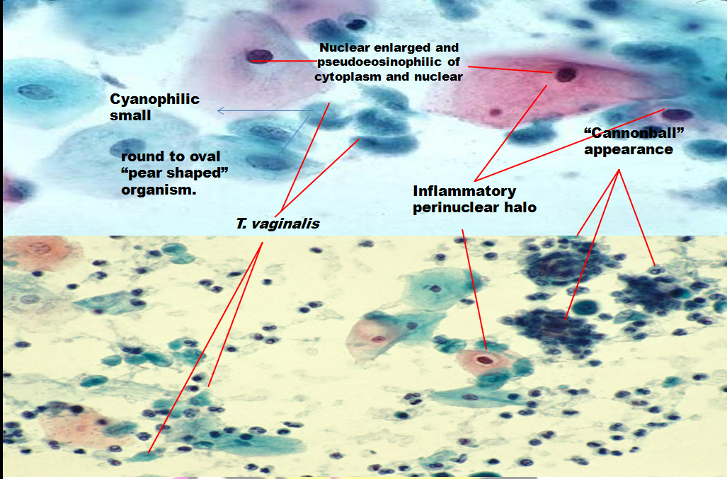infections-in-pap-smear-cellular-changes-associated-with-trichomonas