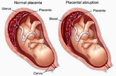 Abruptio Placentae (Placenta Abruption)
