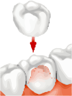 Dental crown pain