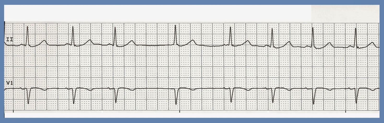 junctional escape rhythm life in teh fast lane junctional escape rhythm life in teh fast lane