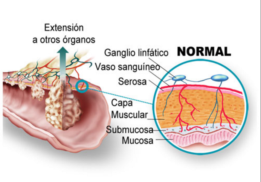 cancer de colon con ganglios afectados