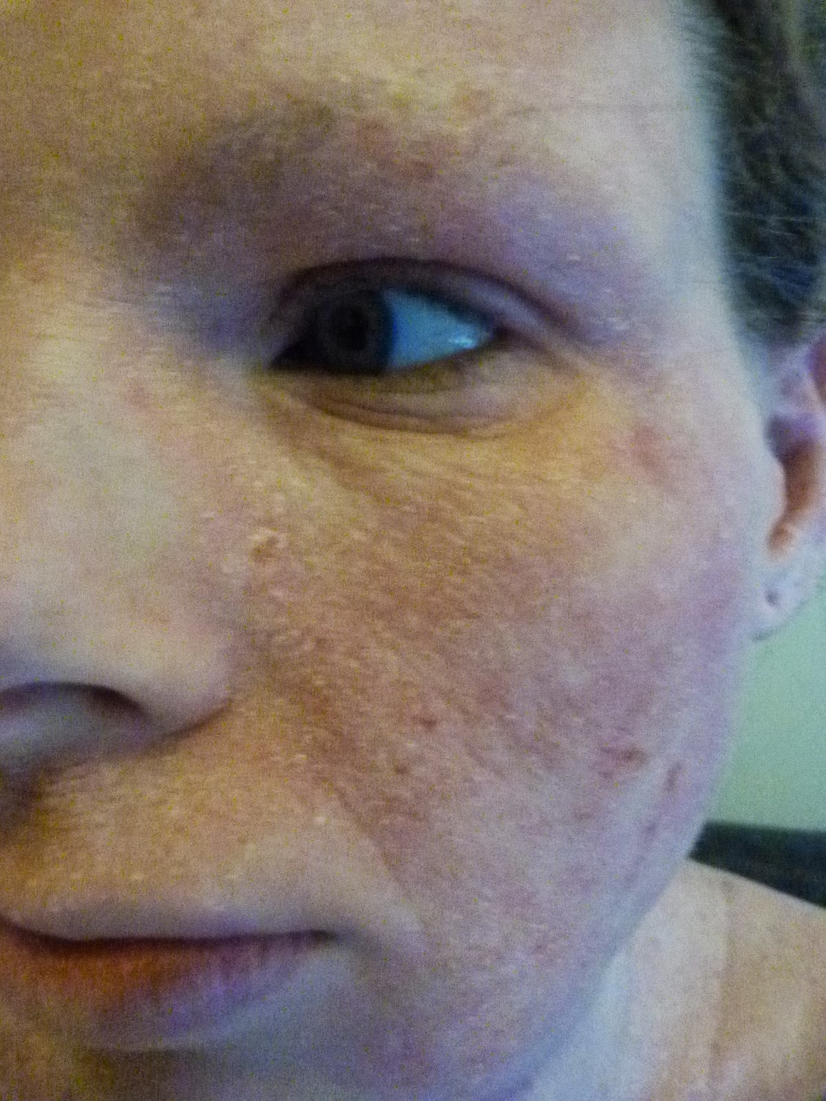 I Have Eczema: Kidding Myself?