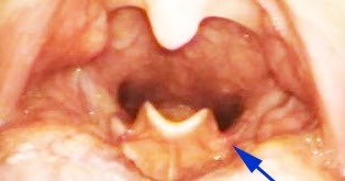 epiglottitis epiglottis cancer throat signs symptoms