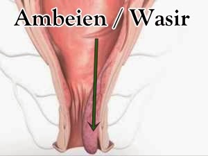 obat wasir cara hembing