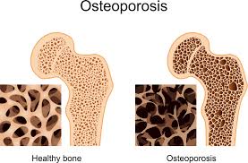 Obat Penyakit Osteoporosis Herbal