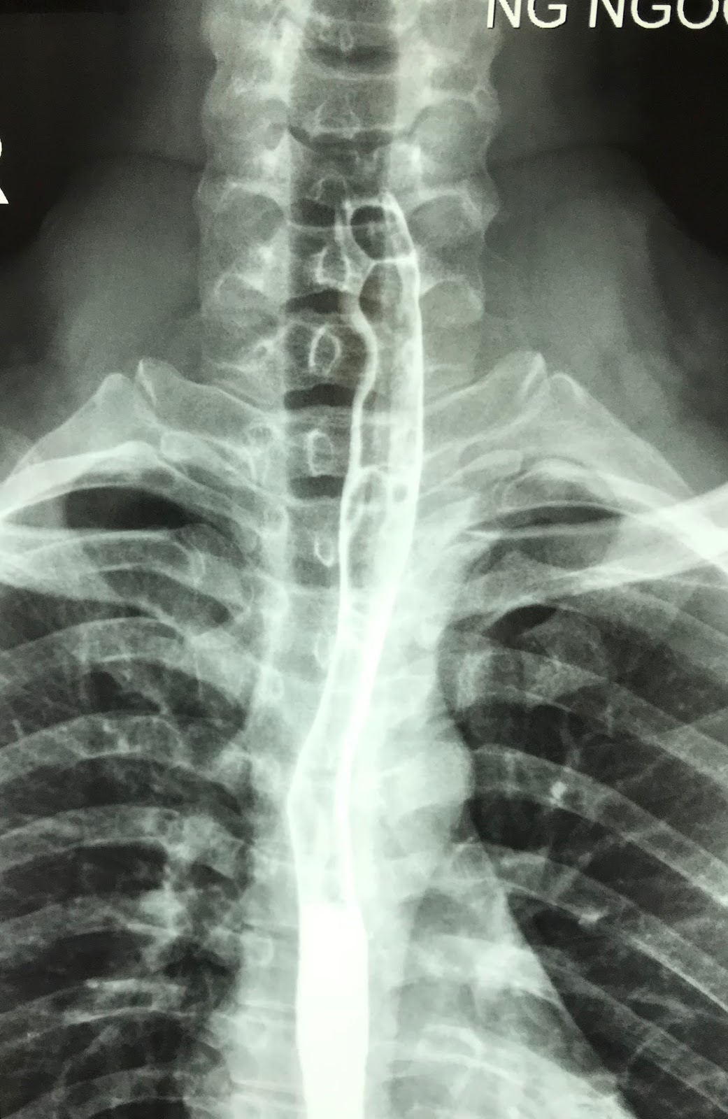 VIETNAMESE MEDIC ULTRASOUND CASE 481 ZENKER’S DIVERTICULUM, Dr PHAN