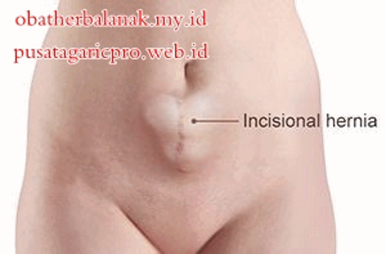 علاج الفتق بدون جراحة علاج الفتق بدون جراحة