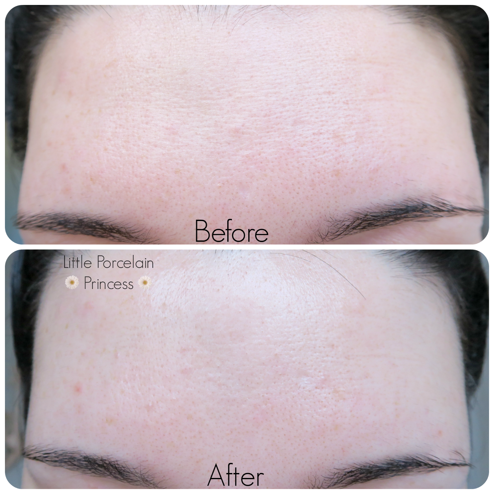 Little Porcelain Princess East VS West CosRX One Step Pimple Clear