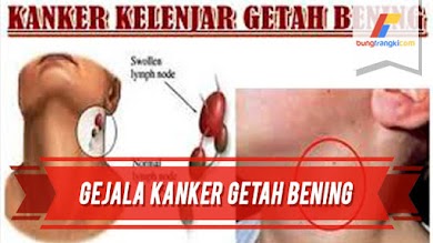 Inilah Gejala Kanker Getah Bening dan Obatnya Inilah Gejala Kanker Getah Bening dan Obatnya