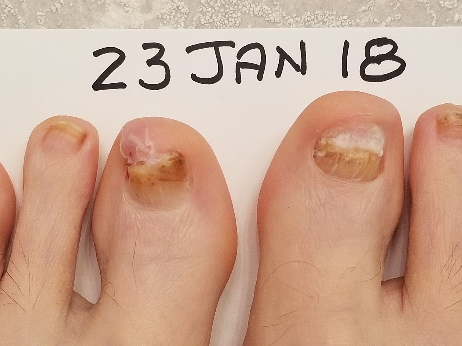 Run with Perseverance A Tale of Two Toenails; How to Fix Runner's Toenails
