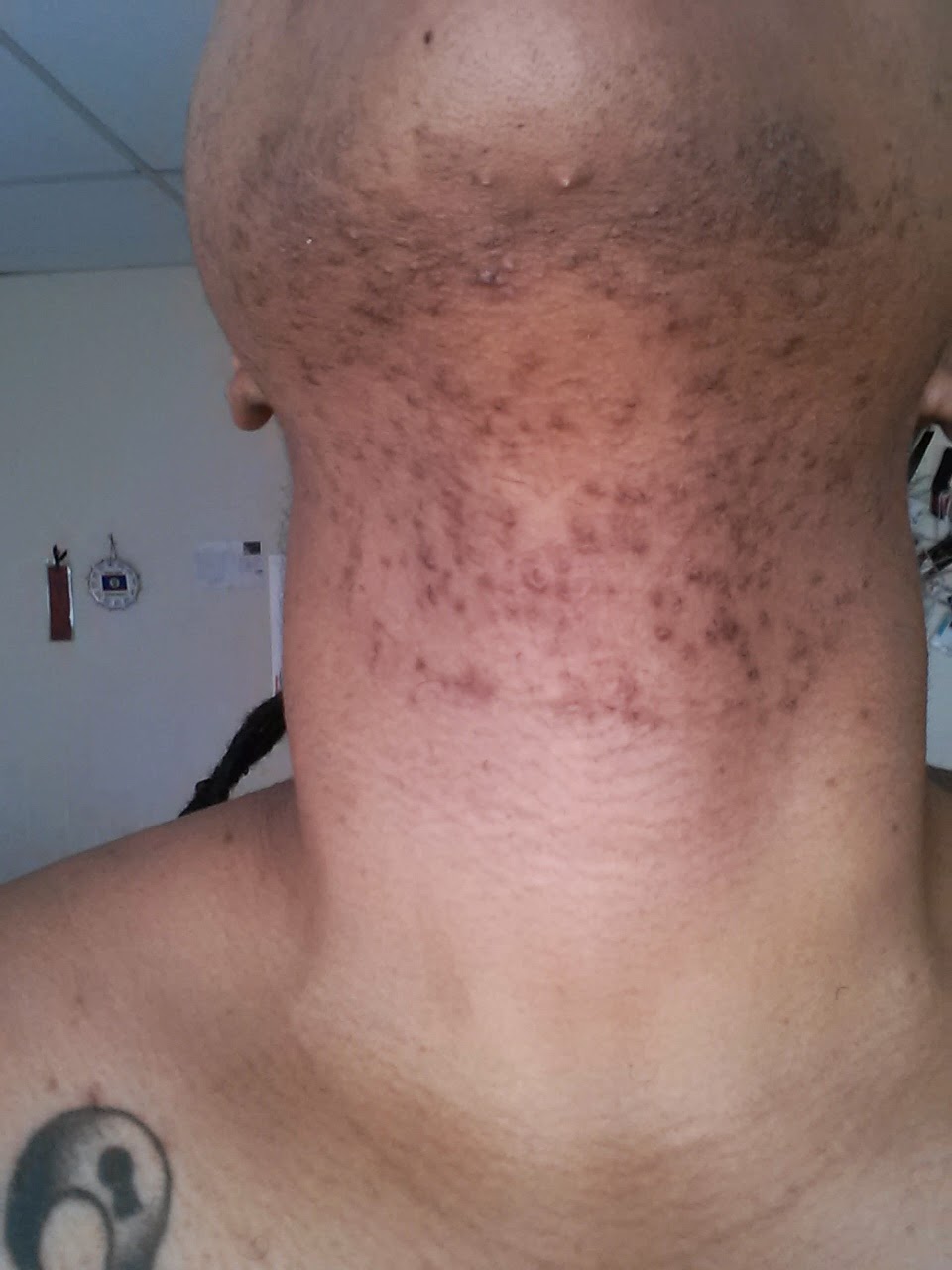 dark spots on neck